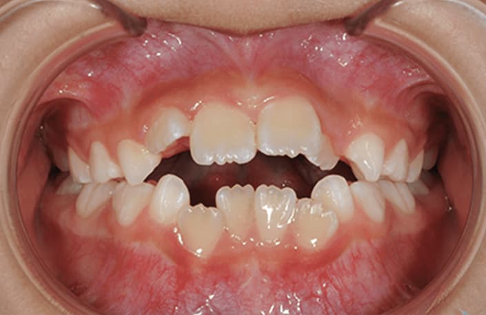 歯がガタガタ、すき間が広い