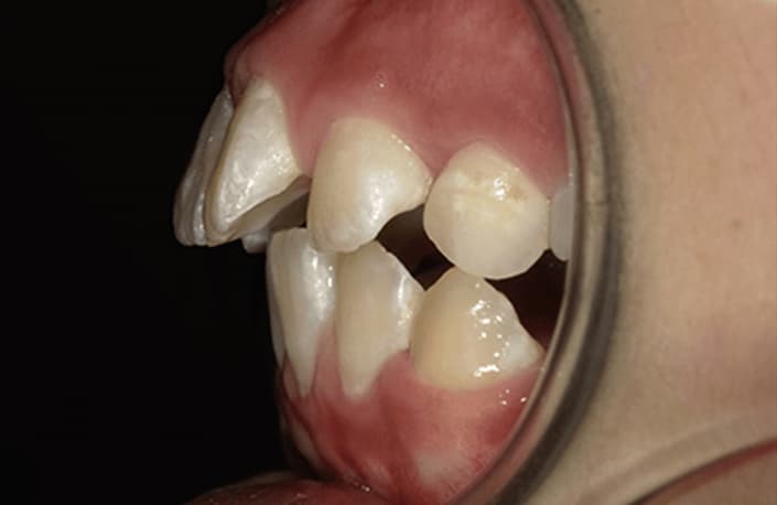 出っ歯・受け口、前歯が閉じない